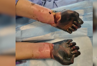 致命感染爆发! 加拿大女子8天内四肢坏死被迫截肢! 健康人也中招