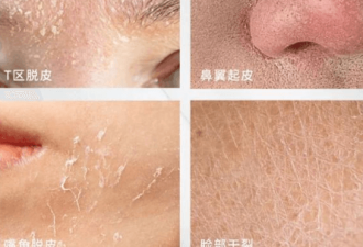 皮肤干燥的4大根源 你可能一直都在踩坑