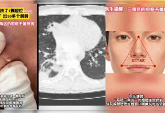 中国男生挤痘痘感染细菌 肺被“啃”出十多个空洞