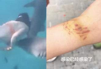 中国女游客生理期潜水 惨遭鲨鱼咬伤