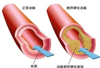 “吃猪油死得快”？真不能吃了吗？