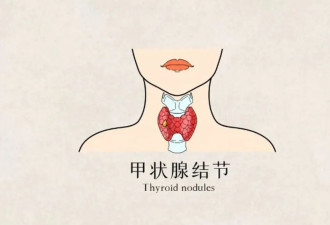 别慌！你的甲状腺结节，99%都不是癌