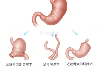 以为只是“没胃口”，怎么就晚期了？