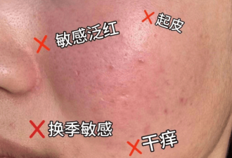 敏感泛红紧急“灭火” 4步稳住肌肤告别红苹果脸