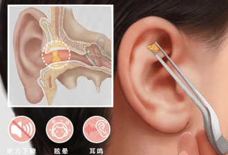 一辈子不掏耳屎，会变聋吗？