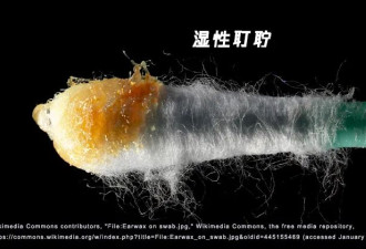 一辈子不掏耳屎，会变聋吗？