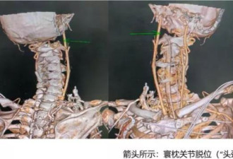 不可能的任务！6旬男“头颈分离”一度命危 医1招奇迹保命