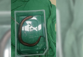 30cm鳝鱼腹腔里游走 湖南男急喊：救救我