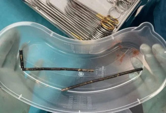 菜刀插进胸膛8年竟浑然不知,这位狠人震惊医学界
