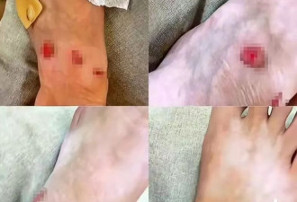女子购LV鞋穿后多处破皮，要求退货却被拒？