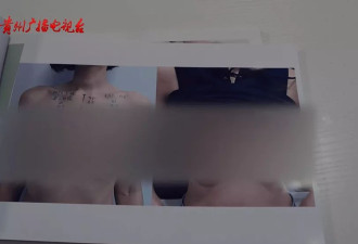 花费四万多隆胸，半夜睡觉却假体翻转
