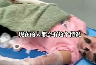 睡觉时手机放枕边充电突爆炸！女子惨毁容 全身7成烧烫伤