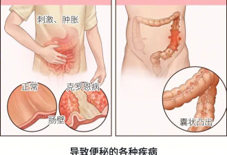 便秘3天，衰老3岁？医生：真的