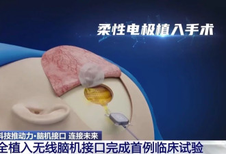 当脑机接口走入生活，会为我们带来哪些新可能？