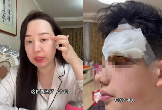 女星替13岁儿子挑痘酿祸 害缝4针自责"心如刀割"