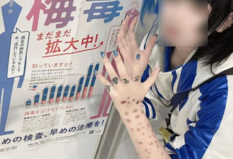 奇葩！日本年轻人热衷晒梅毒疤？感染人数连年暴增引担忧！