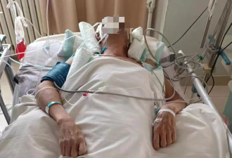 患者右脑出血被内蒙医生开左脑手术，住ICU80多天