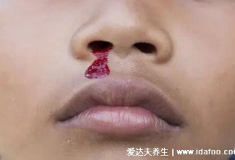 儿童白血病流鼻血特点 不易止住出血量大