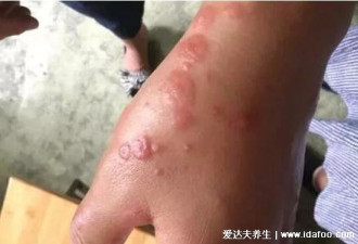 一个月不发烧排除艾滋病 不准确潜伏期可达15年