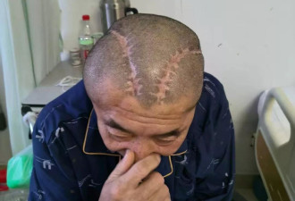 家属称男子三年前右脑出血被开左脑,医生发现出错又开右脑