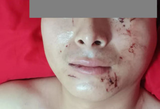 男子新婚夜被妻子抓伤 事后查到家中有精神类药物