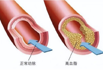 降血脂不只靠吃药：这五个习惯同样关键