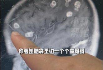 河南6岁女孩脑子被“啃”20个洞 原因竟是…