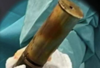 怎么来的？ 法国24岁男子肛门塞入骨董炮弹 惊动拆弹专家
