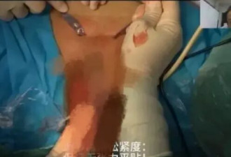 陕西医院手术直播 突现女患者私处 5万人涌入抢看