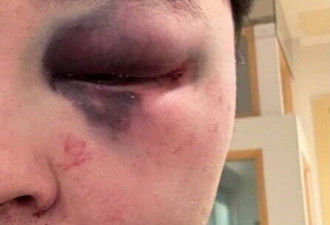 中国留学生买菜回家遭暴打！头骨骨折右眼手术，凶手仍在逃