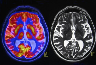 重大突破！科学家找到帕金森病因