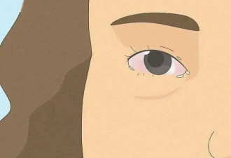 晨起“眼屎”糊眼 是哪里出了问题?
