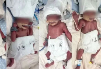 24岁产妇凌晨生下5胞胎（1男4女），最重1030克
