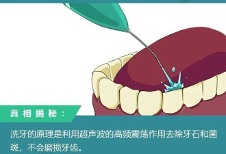 洗牙的8大传言，据说99%的中国人都信了