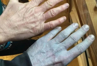 他全身发蓝，被紧急送医！真相曝光 网民惊呆
