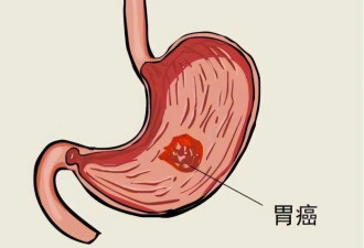 胃癌，为何一发现就是中晚期？