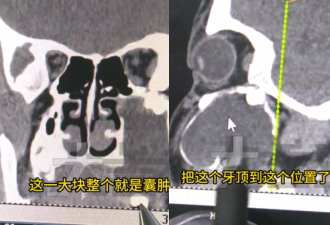 15岁中国少年嘴歪竟是“智齿长到眼窝里”