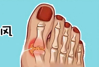 痛风不只是吃出来的痛 6个习惯也容易中招