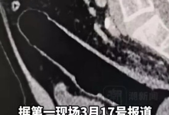 假阳具“滑入肛门” 他忍3天就医：不小心坐到