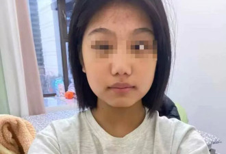 山东16岁女子全身90%烧伤：家属筹款，嫌疑人被批捕