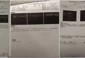 74页病历被修改30次 男子做骨折手术 神经损伤