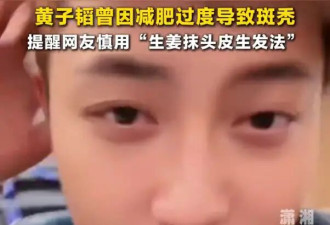 黄子韬否认秃顶传闻！自曝因过度减肥导致斑秃，用生姜抹头导致脱发加剧
