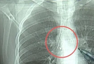 小伙体检发现胸腔有根针,父母回忆或是1岁时扎入