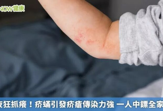 半夜痒到崩溃！是它在皮肤“挖隧道产卵” 一人中镖全家遭殃