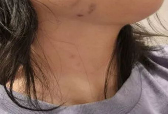 27岁中国女澳洲遭辱骂狂殴 满面鲜血 需辞职休养