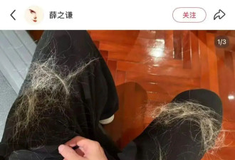 薛之谦晒图自曝“满头斑秃和水泡”！反复漂染发头皮损伤