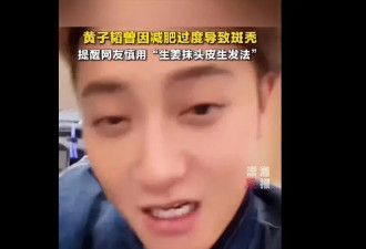 薛之谦晒图自曝“满头斑秃和水泡”！反复漂染发头皮损伤