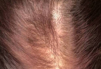 男性秃头减少 DNA研究揭人类外貌惊人变化