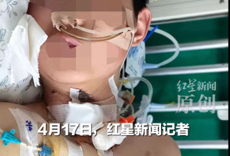 骑车遭割喉的13岁男孩已苏醒，目前无法说话