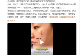 杨蓉晒烫伤后疤痕恢复照 称带疤的脸很酷